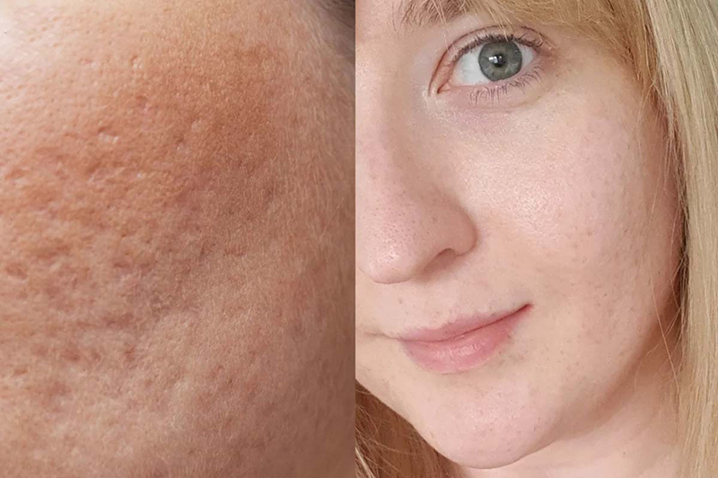 cách chăm sóc da bị sẹo lõm