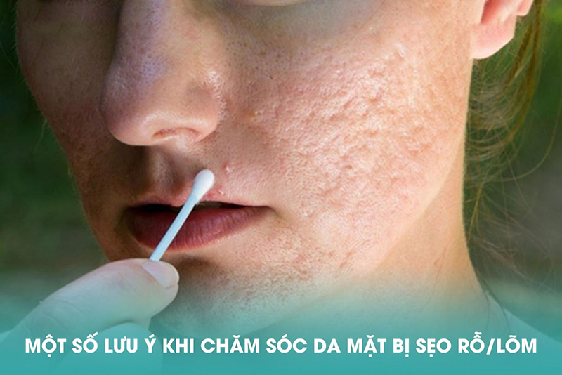cách chăm sóc da bị sẹo lõm
