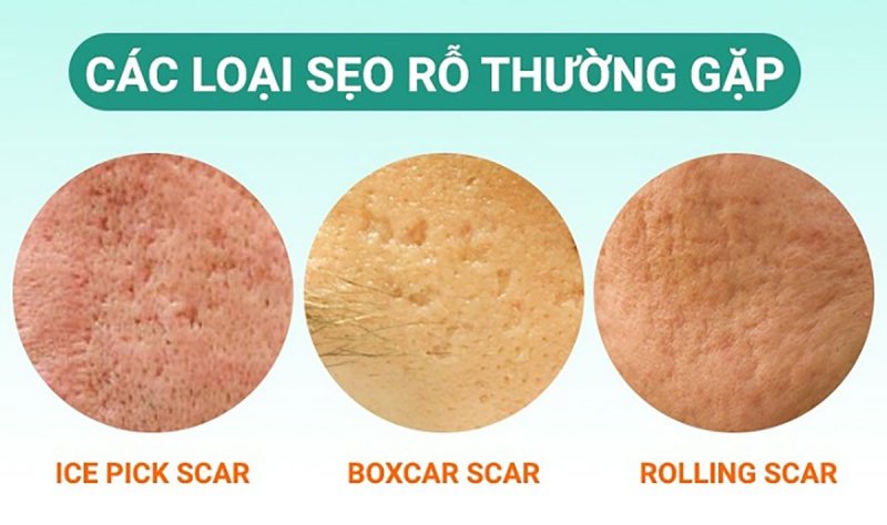 cách chăm sóc da mặt bị rỗ
