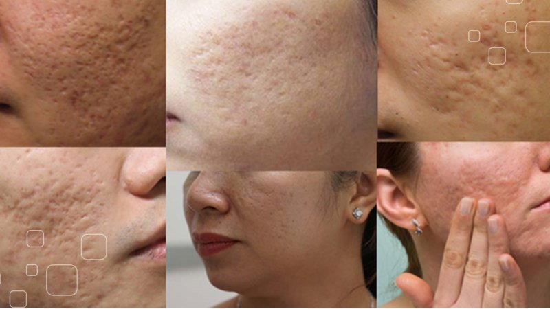 cách chăm sóc da mặt bị rỗ