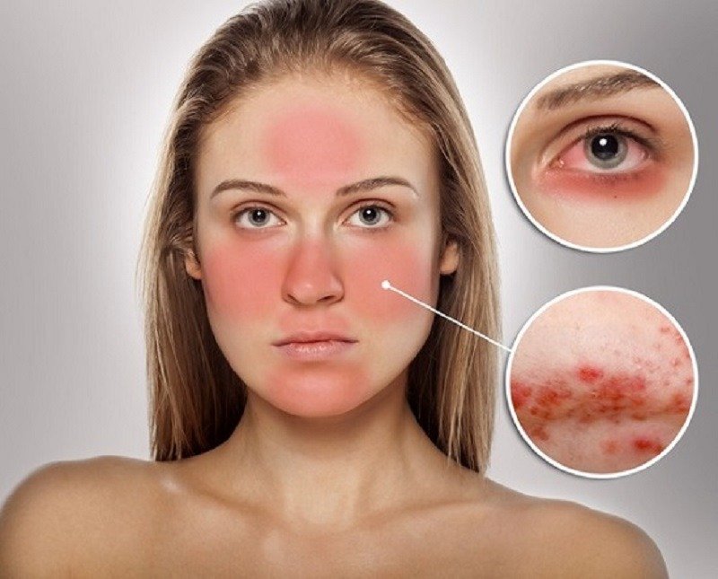 điều trị mụn cho da nhạy cảm