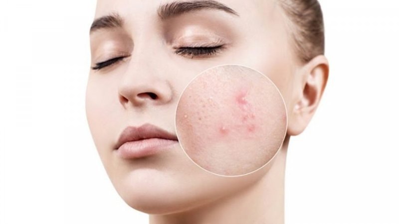 điều trị mụn cho da nhạy cảm