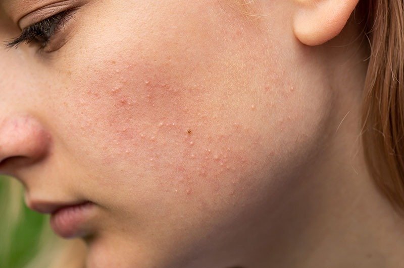 điều trị mụn cho da nhạy cảm