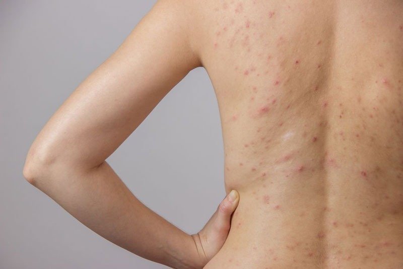 điều trị viêm da tiết bã