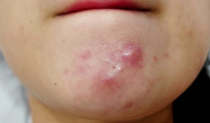 nguyên nhân và cách điều trị mụn bọc
