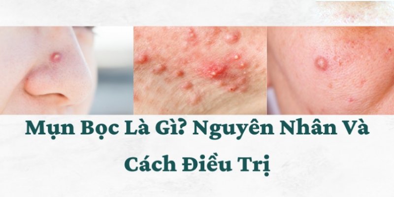 nguyên nhân và cách điều trị mụn bọc