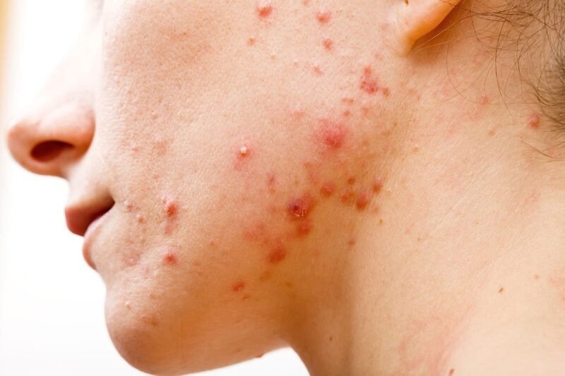 nguyên nhân và cách điều trị mụn bọc